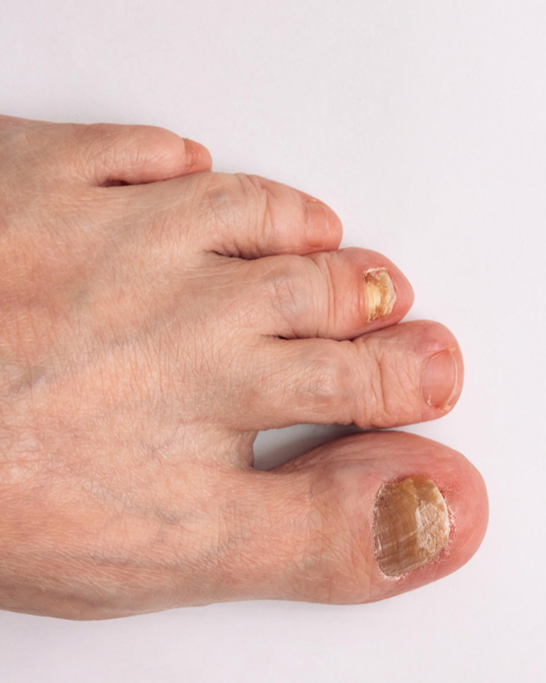 Onicomicosis Aftercare